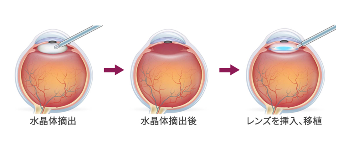 水晶体摘出、水晶体摘出後、レンズを挿入、移植の図