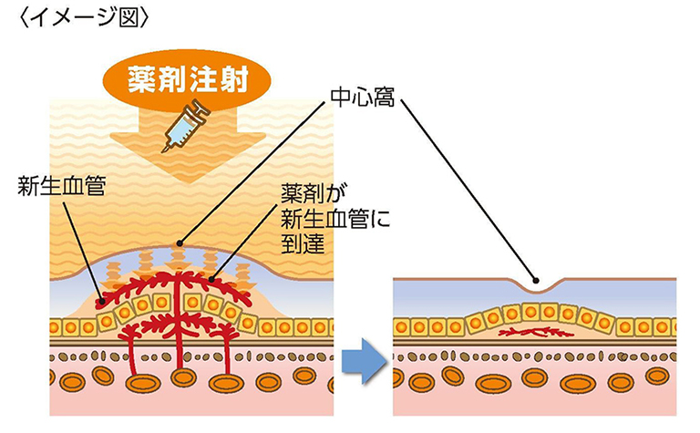 薬剤注射