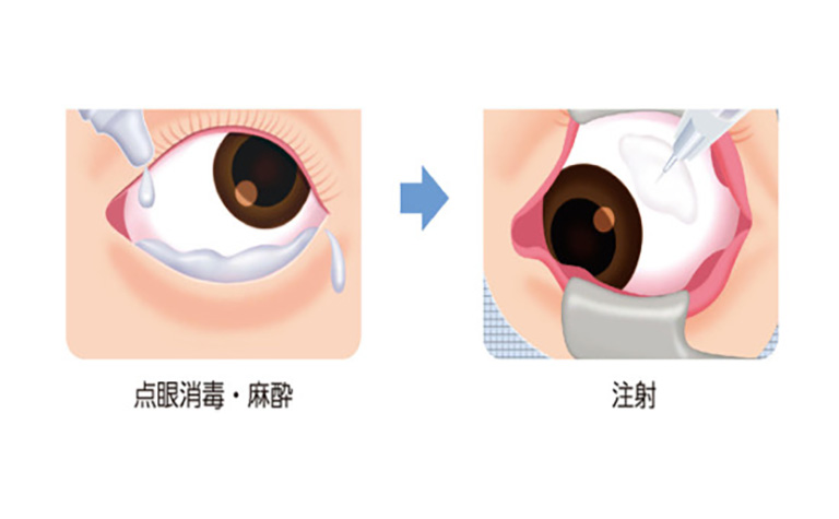 点眼消毒・麻酔
