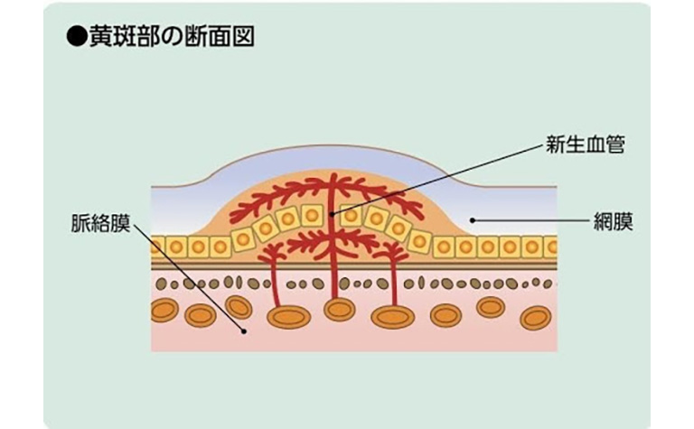 加齢黄斑変性症