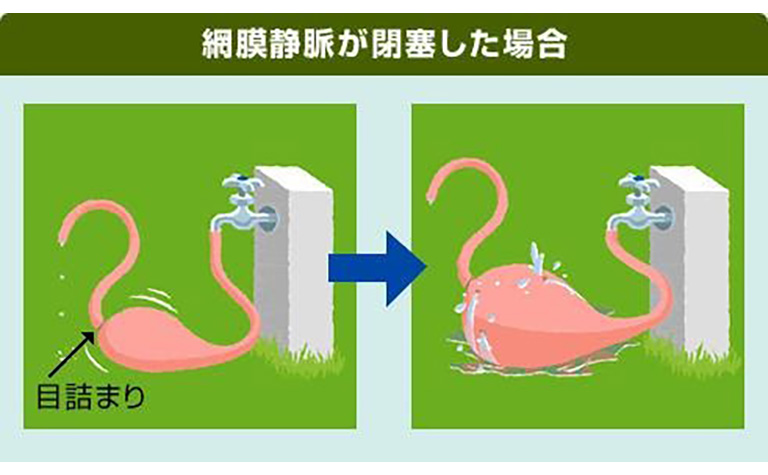 網膜静脈閉塞症に伴う黄斑浮腫