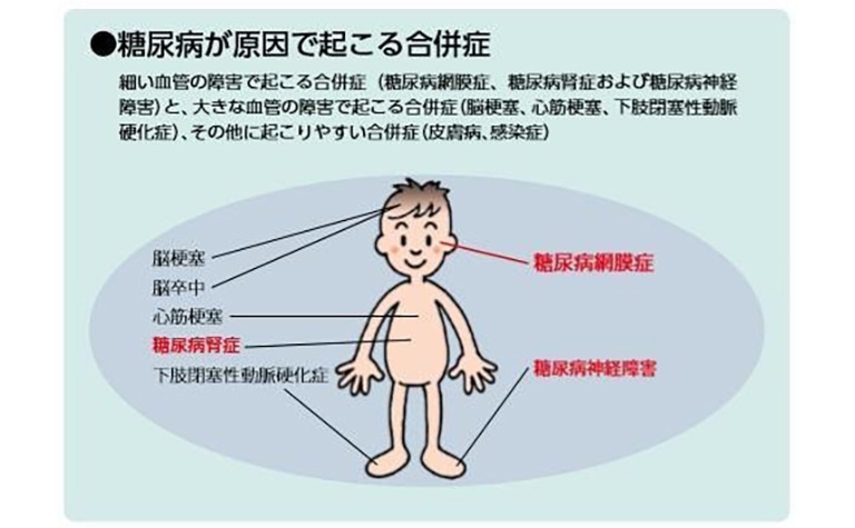 糖尿病網膜症に伴う黄斑浮腫