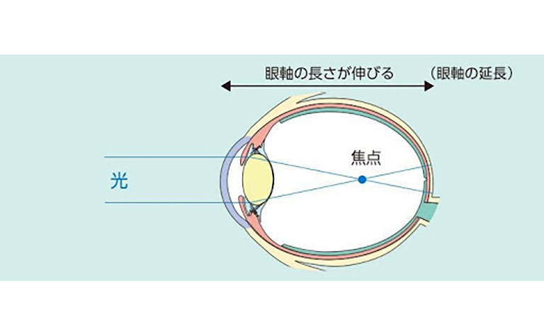 病的近視による脈絡膜新生血管