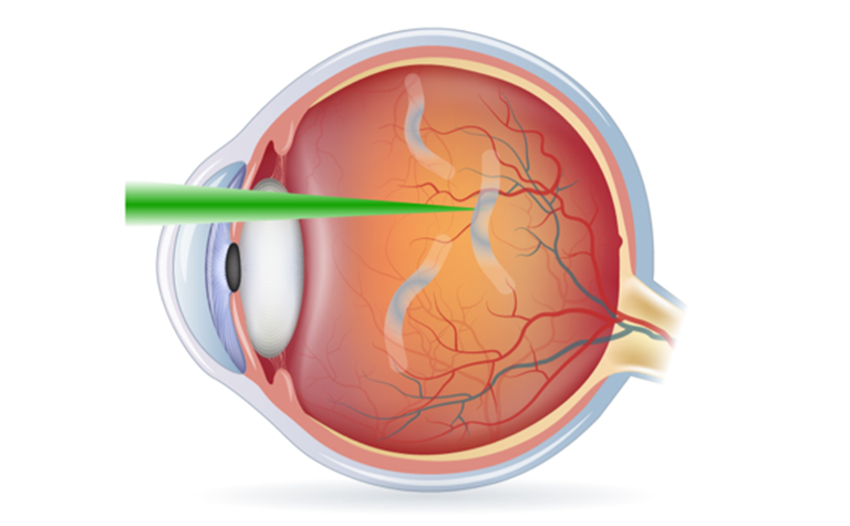 レーザービトレオライシス